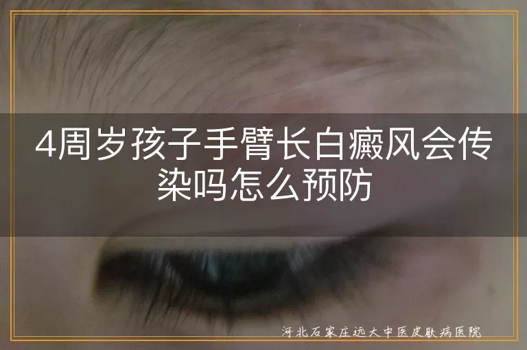 儿童白癜风传染性分析,儿童手臂白斑预防策略,4岁儿童白癜风日常护理