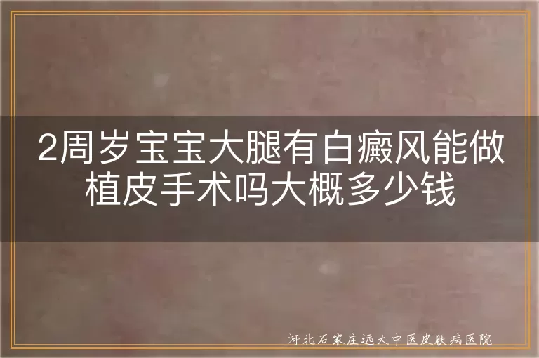 两岁宝宝大腿白斑手术可行性,儿童白癜风植皮手术条件,幼龄患者白癜风治疗费用咨询