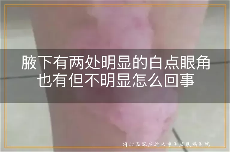 腋下白斑眼角症状鉴别,白癜风腋下眼角早期特征,腋下眼角白斑病因分析