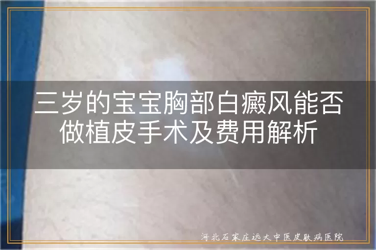 三岁儿童白癜风植皮手术条件,胸部白斑植皮手术费用,儿童白癜风治疗费用范围