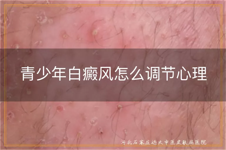 青少年白癜风心理调节方法,青少年白斑病心理疏导,白癜风青少年情绪管理