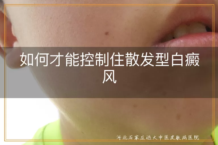 散发型白癜风日常管理要点,控制散发型白癜风扩散策略,散发型白癜风综合治疗方法