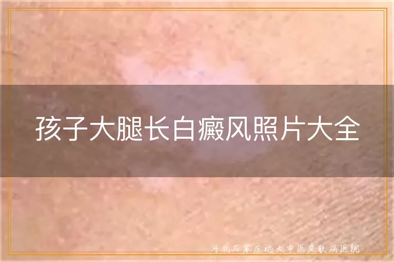 儿童大腿白斑图片鉴别,青少年白癜风初期症状照片,孩子腿部白斑发展阶段图解