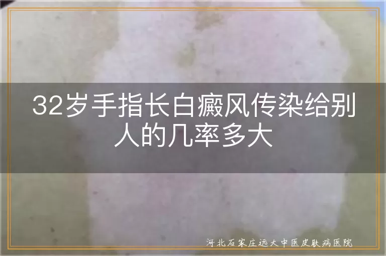 手指白癜风传染风险评估,32岁白癜风患者传染性分析,白癜风是否会通过接触传播