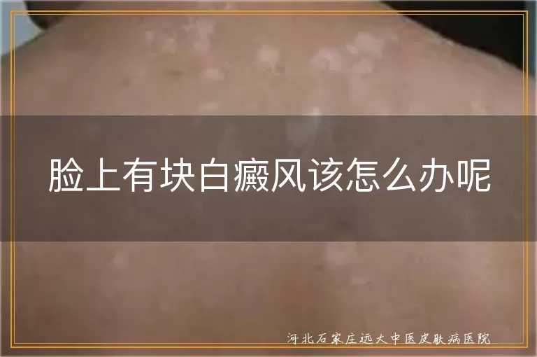 脸上有块白癜风该怎么办呢
