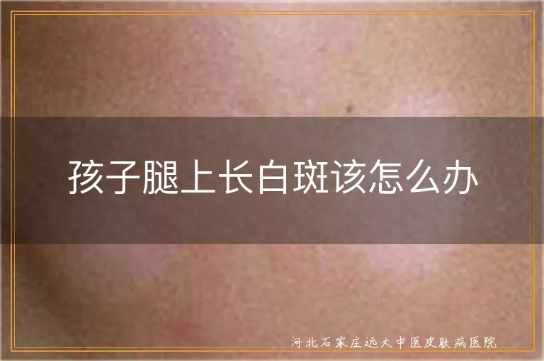 孩子腿上长白斑该怎么办