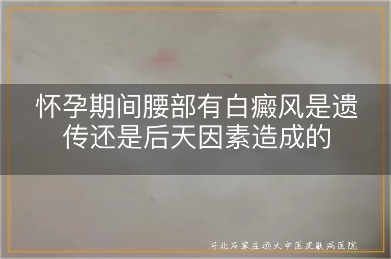 怀孕期间腰部有白癜风是遗传还是后天因素造成的