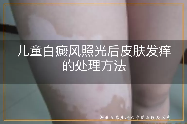 儿童白癜风照光后皮肤发痒的处理方法