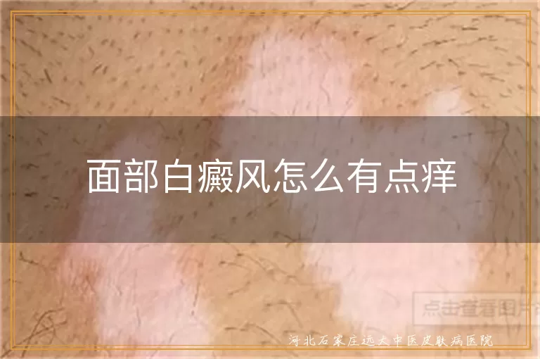 面部白癜风怎么有点痒