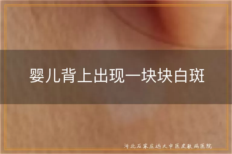 婴儿背上出现一块块白斑