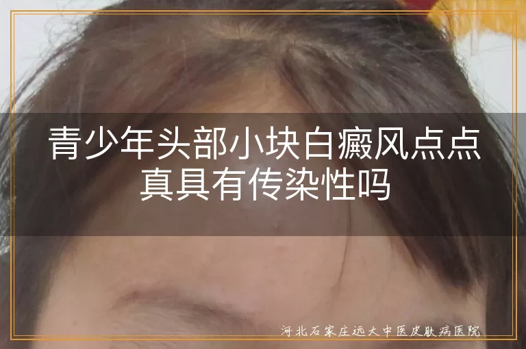 青少年头部白癜风传染风险解析,青少年白斑是否具备传染性,白癜风遗传性与传染性差异