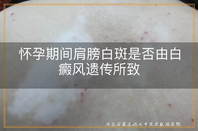 怀孕期白斑遗传可能性,孕期白癜风遗传风险,肩部白斑与白癜风关联