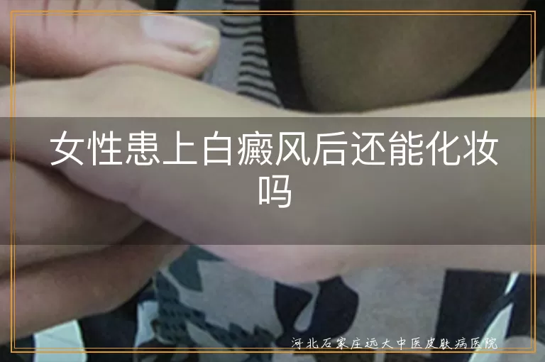 白癜风患者能否使用化妆品,白斑部位化妆需注意什么,女性白癜风患者日常护肤建议