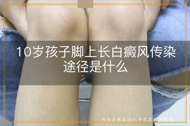 儿童脚部白癜风是否传染,10岁孩子白斑传播途径解析,青少年白癜风传染机制探究