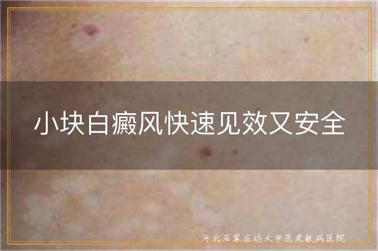小块白癜风快速见效又安全