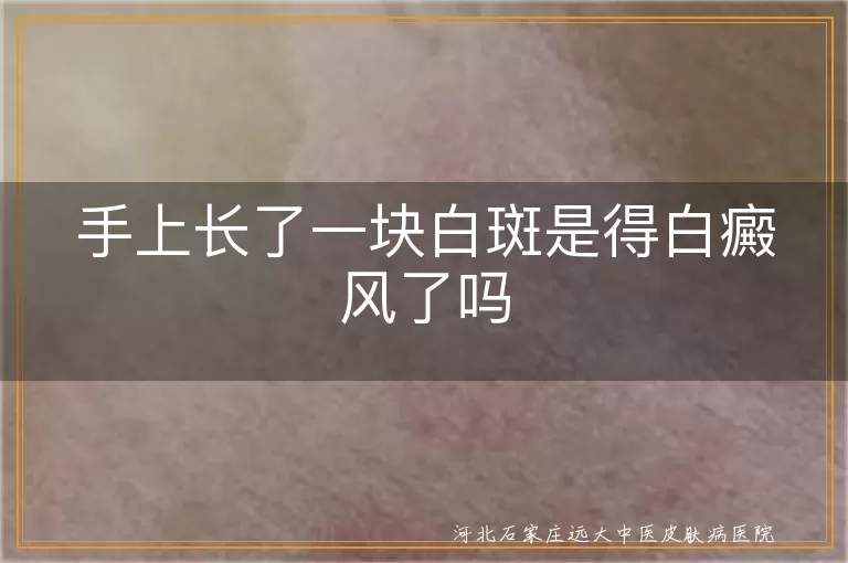 手上白色斑片会是白癜风吗,白斑迟迟不褪是不是白癜风,白癜风早期症状如何判断
