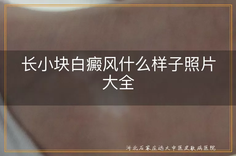 小块白癜风典型照片展示,早期白斑高清图集,初期白癜风样子图片