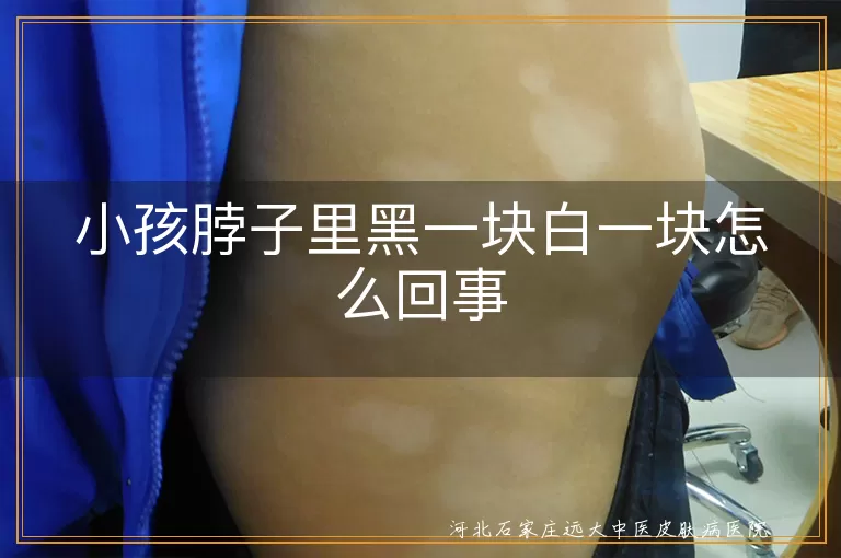 儿童颈部白癜风早期表现,小孩白斑黑皮并存原因,颈部色差警惕白癜风