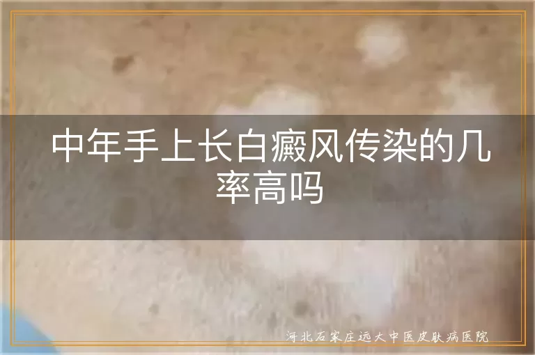 中年手部白癜风是否传染你知道吗,白癜风不会通过接触传播的真相,手上白斑是不是白癜风传染误区