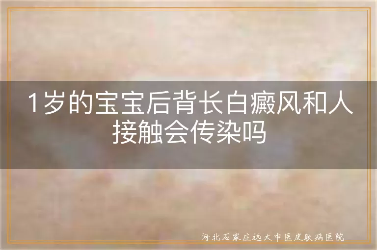 1岁宝宝后背白斑会不会传染,婴幼儿白癜风家长担心啥,白癜风白斑到底传不传