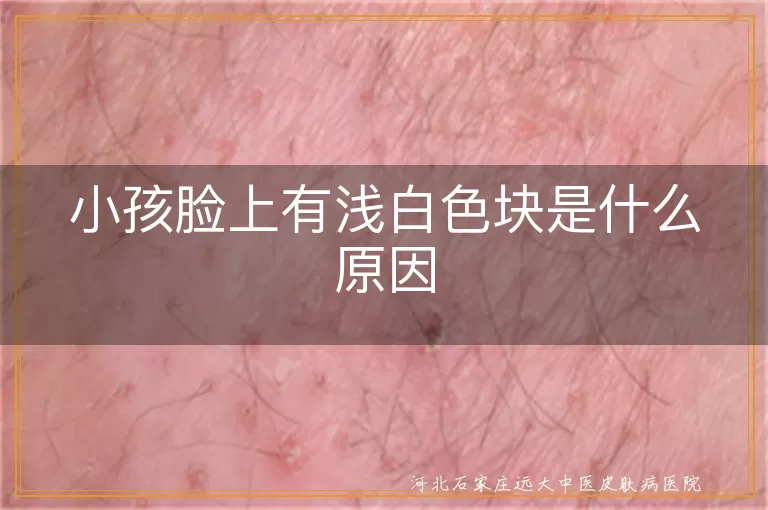 白癜风儿童早期脸部长白斑,小孩浅白色皮肤斑块怀疑白癜风,儿童面部白斑与白癜风鉴别要点