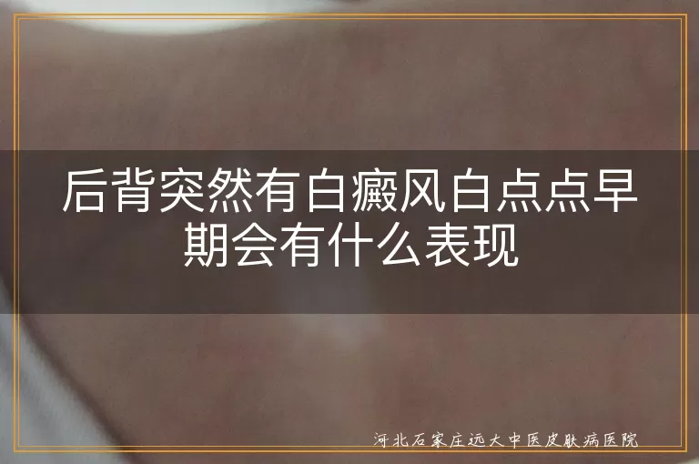 后背白癜风初期征兆,白斑在背部初期表现,白癜风白点点预兆