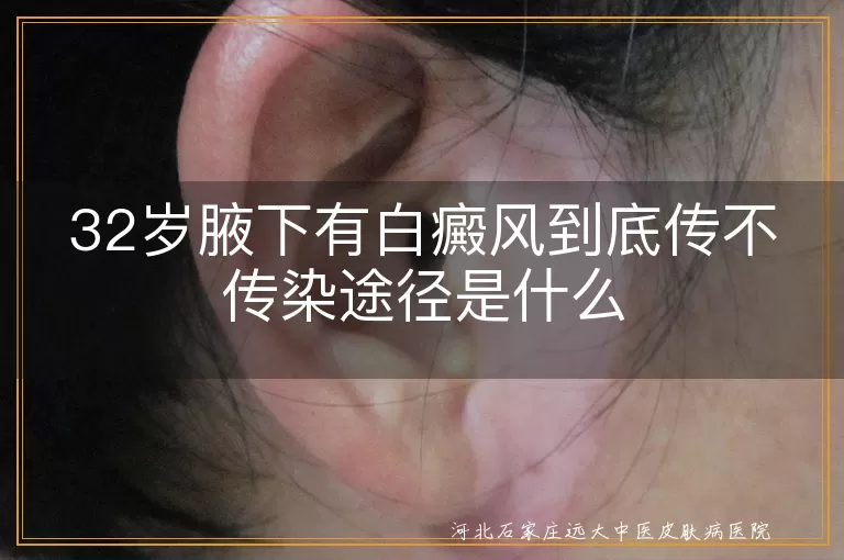 32岁腋下有白癜风到底传不传染途径是什么