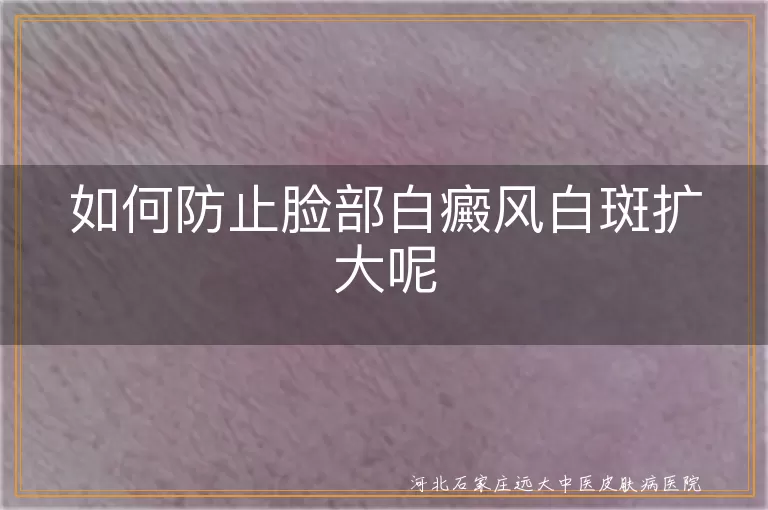 如何防止脸部白癜风白斑扩大呢