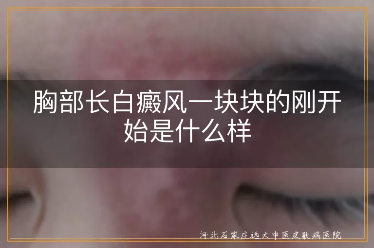 胸口白癜风早期症状,白斑初现样子分析,初期白癜风表现