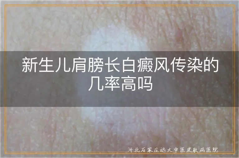 新生儿肩膀白斑传染可能,白癜风家族遗传概率,婴儿白癜风不会人传人