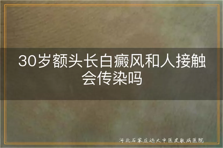 30岁额头长白斑会不会传给别人,白癜风日常接触不具传染性,额头白斑心理安抚