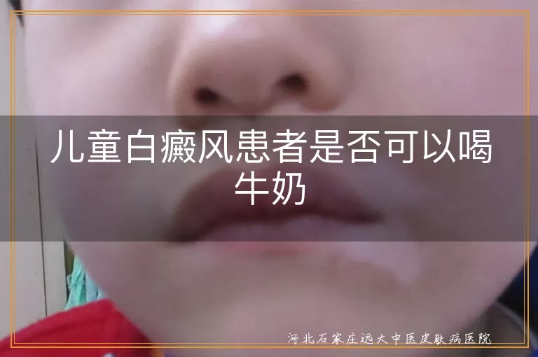 儿童白癜风能否喝牛奶,白斑患儿饮奶注意事项,白癜风儿童牛奶摄入指南