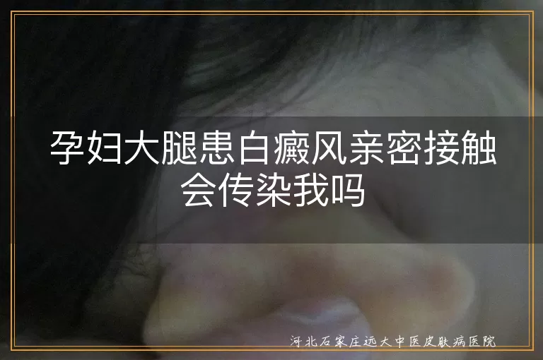 孕妇大腿白斑会传吗,与白癜风爱人亲密,大腿白斑亲密接触风险