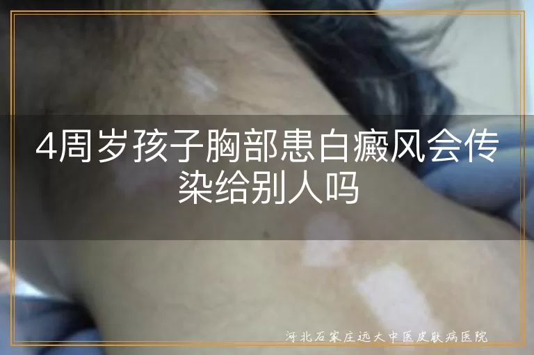 4岁童胸白斑真相,小朋友白斑会传不,白癜风日常相处指南