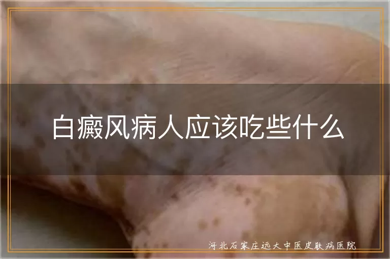 白癜风病人应该吃些什么