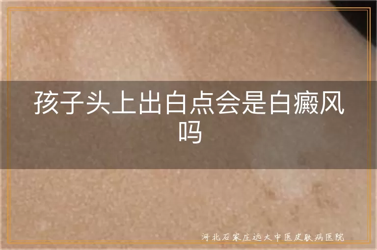 儿童头皮白斑会不会是白癜风,白癜风儿童早发现,宝宝头皮白斑鉴别