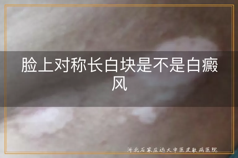 脸上对称白斑是白癜风吗,双侧面部白斑判断白癜风,面部长白癜风早期症状