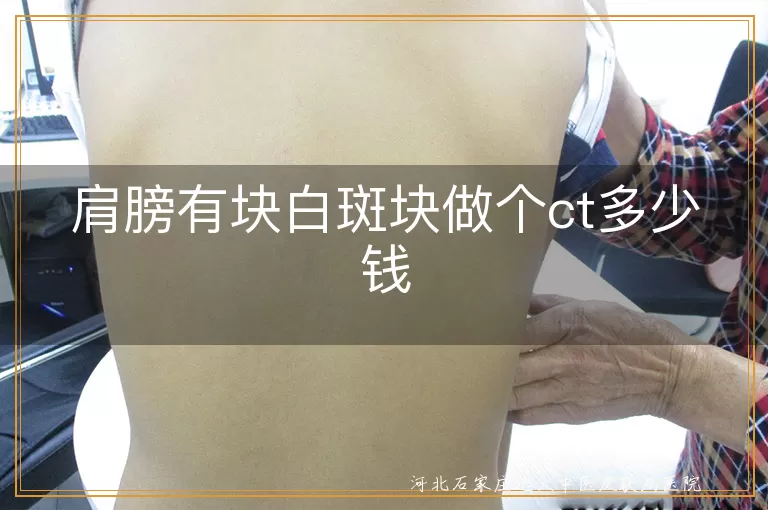 肩膀白癜风ct检查费用,肩部白斑需要ct多少钱,肩白癜风影像检查价格
