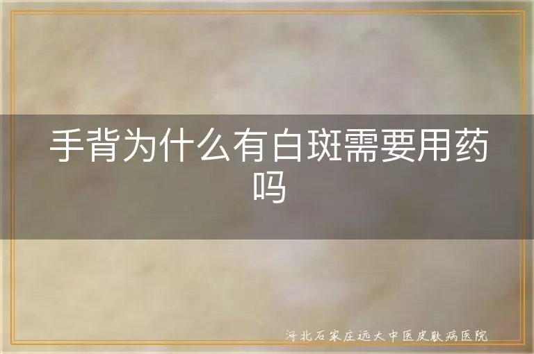 手背白癜风初期是否需用药物,白斑长在手上要不要治疗,白癜风外露白斑药物必要性