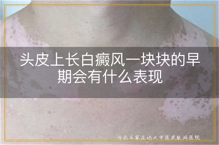 头皮白癜风早期模样,白斑初现头皮信号,白癜风头皮块状征兆
