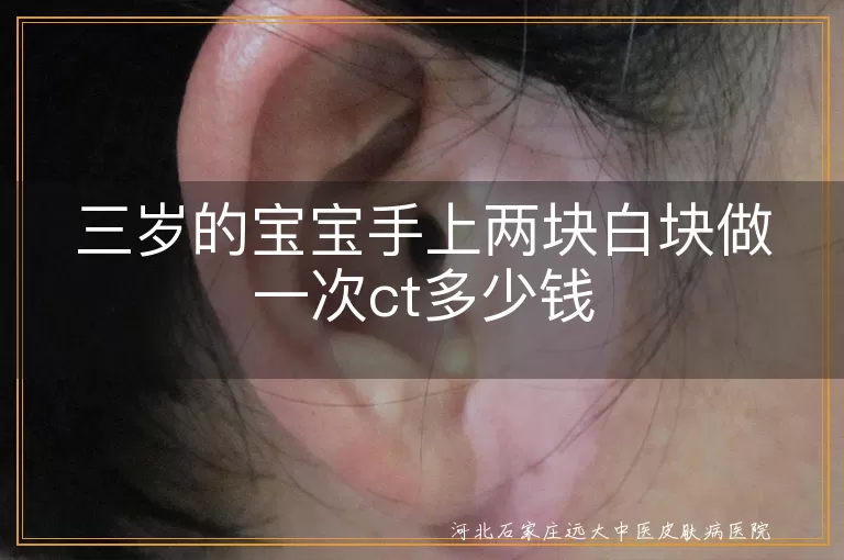 三岁宝宝白癜风ct检查多少钱,白斑初期如何检查价格,儿童手部白斑ct费用