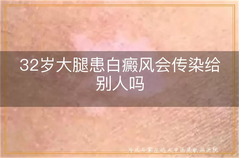 32岁大腿患白癜风会传染给别人吗