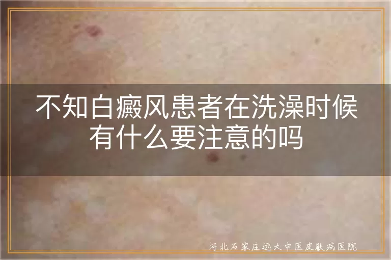 洗澡护理白癜风患者要注意哪些细节,白癜风患者洗澡时水温把握与皮肤保护,白斑沐浴习惯对病情的影响