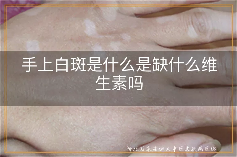 手上长白斑补啥维生素,指端白斑就是白癜风吗,白斑患者饮食与维生素补充