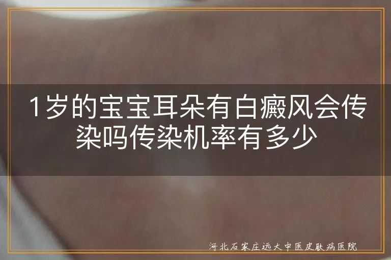 1岁宝宝耳部白癜风白斑,婴儿白斑会传人吗,白癜风传染几率多大