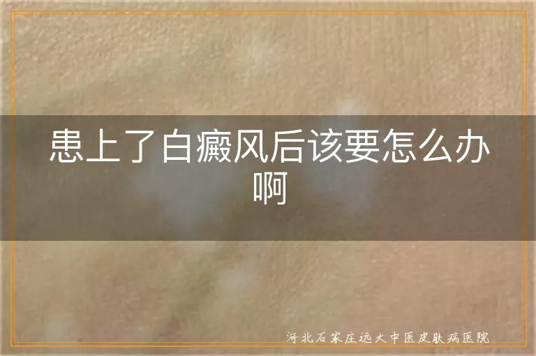 患上了白癜风后该要怎么办啊