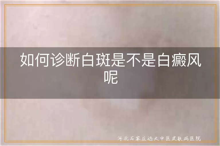如何诊断白斑是不是白癜风呢