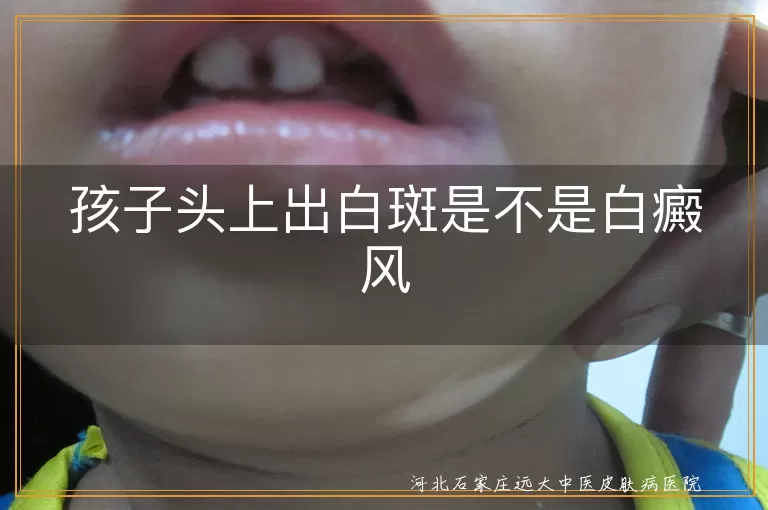 孩子头上出白斑是不是白癜风