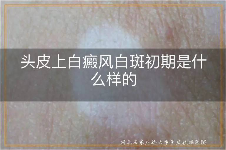 头皮上白癜风白斑初期是什么样的