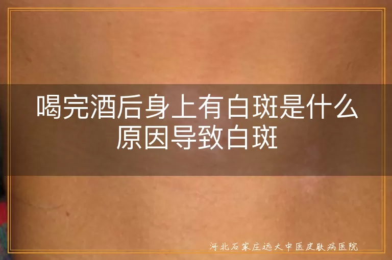 喝完酒后身上有白斑是什么原因导致白斑